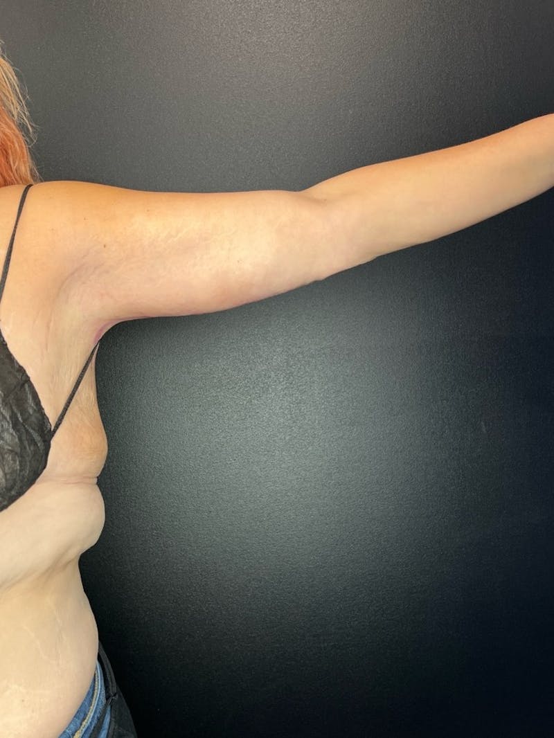 Arm Lift Before & After Gallery - Patient 134878 - Image 2