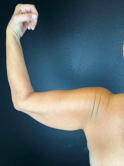 Arm Lift Before & After Gallery - Patient 427607 - Image 1