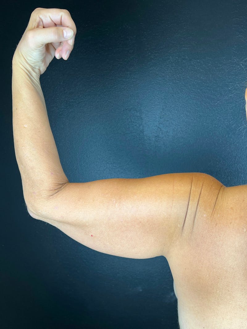 Arm Lift Before & After Gallery - Patient 427607 - Image 1