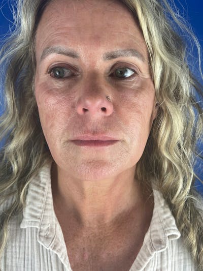 Lip Lift Before & After Gallery - Patient 341087 - Image 1