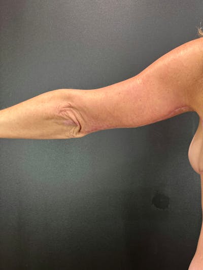 Arm Lift Before & After Gallery - Patient 931311 - Image 2