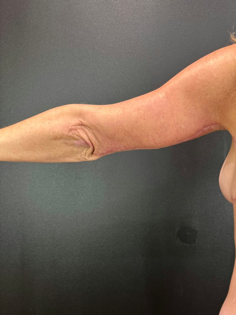 Arm Lift Before & After Gallery - Patient 931311 - Image 2