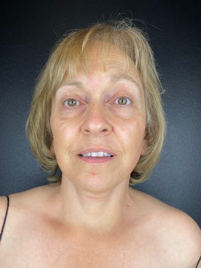 Panfacial Fat Grafting Before & After Gallery - Patient 368550 - Image 2