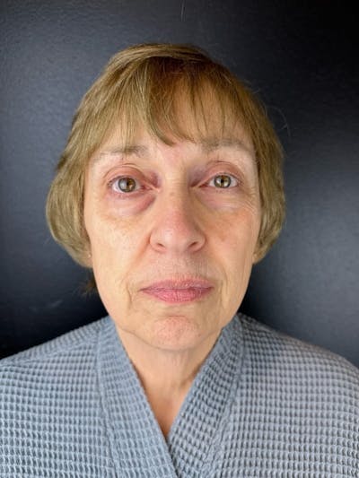 Panfacial Fat Grafting Before & After Gallery - Patient 368550 - Image 1