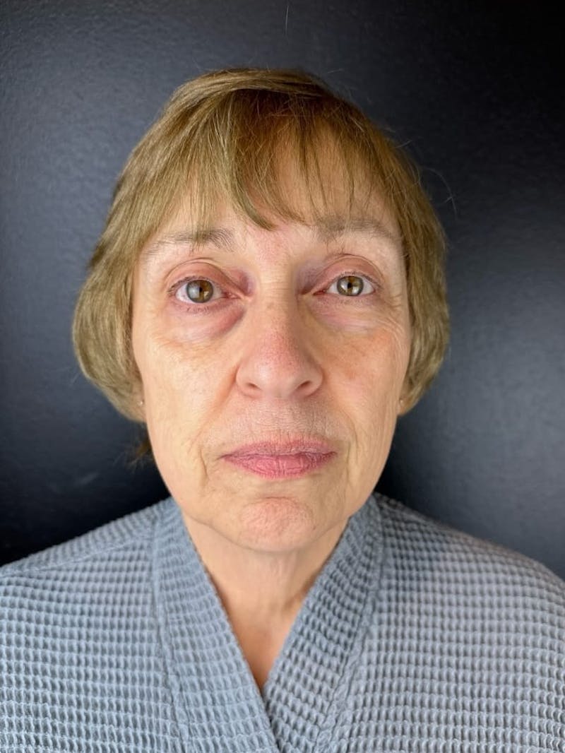 Facelift Before & After Gallery - Patient 679849 - Image 1