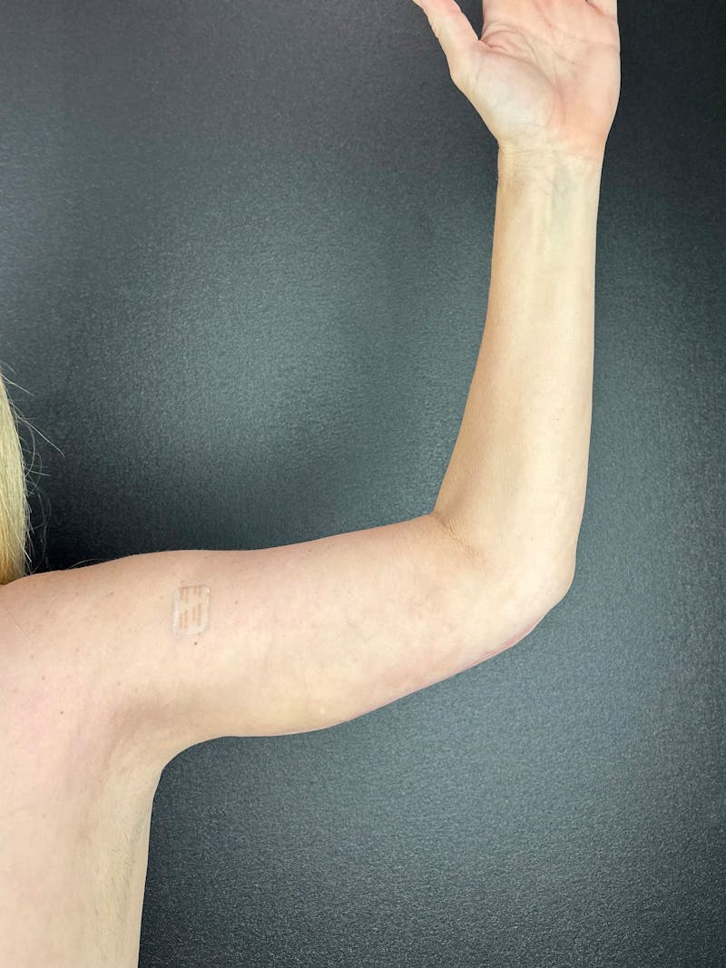 Arm Lift Before & After Gallery - Patient 366266 - Image 2