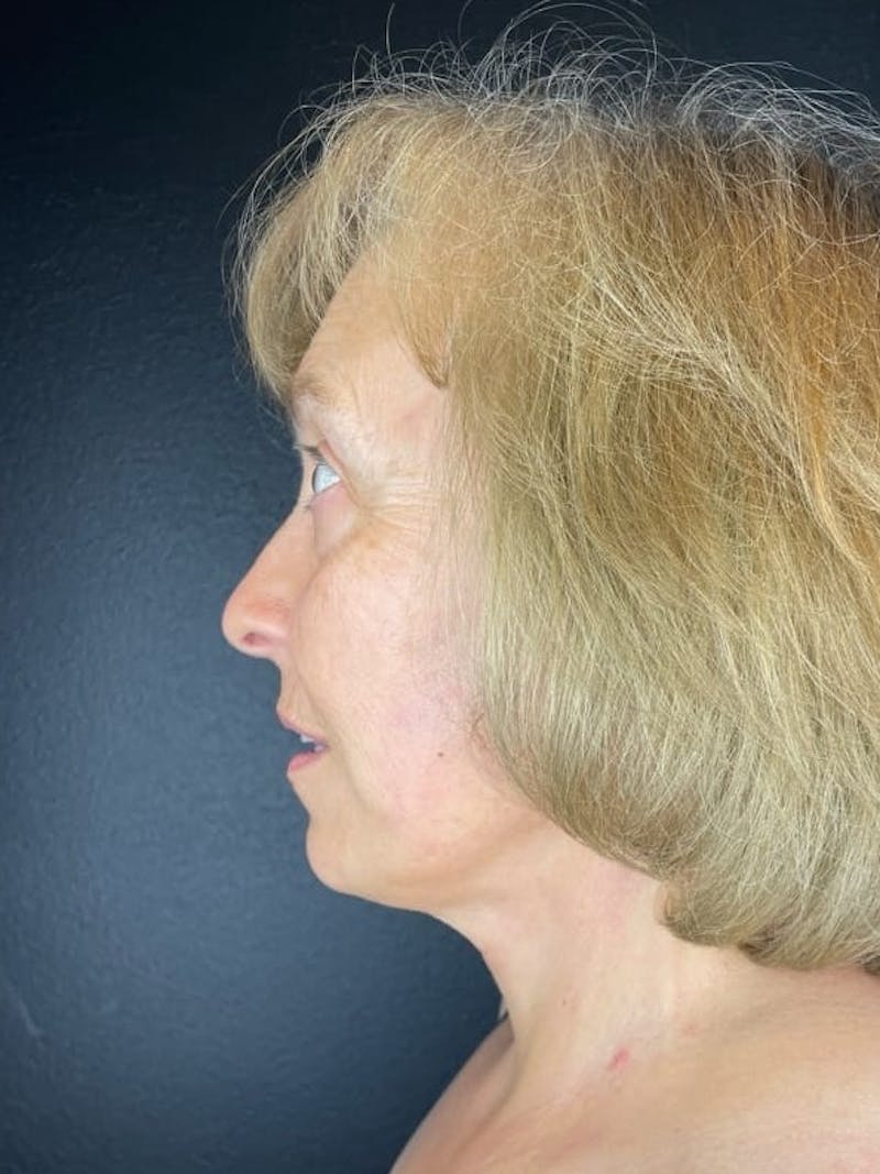 Facelift Before & After Gallery - Patient 679849 - Image 4