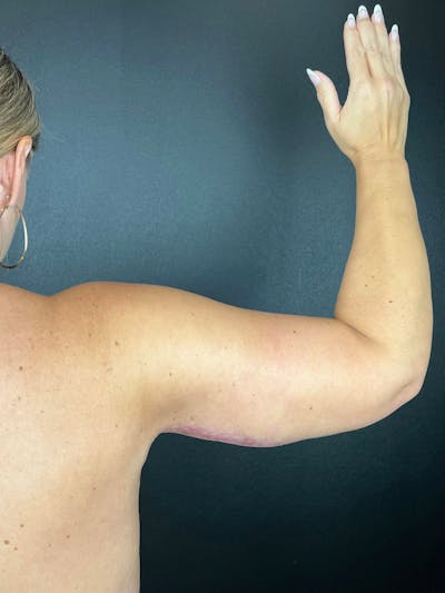 Arm Lift Before & After Gallery - Patient 376183 - Image 2