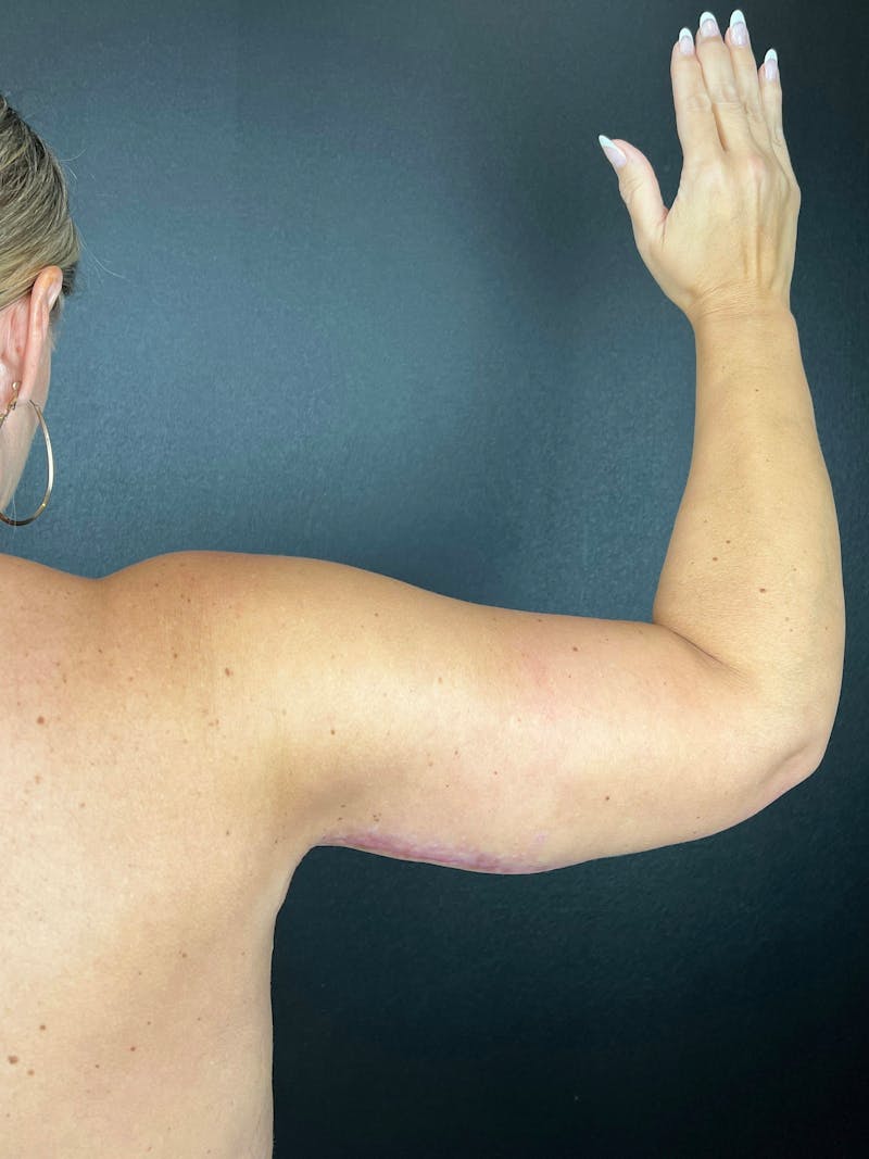 Arm Lift Before & After Gallery - Patient 376183 - Image 2