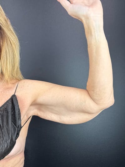 Arms (Brachioplasty) Before & After Gallery - Patient 270194 - Image 1