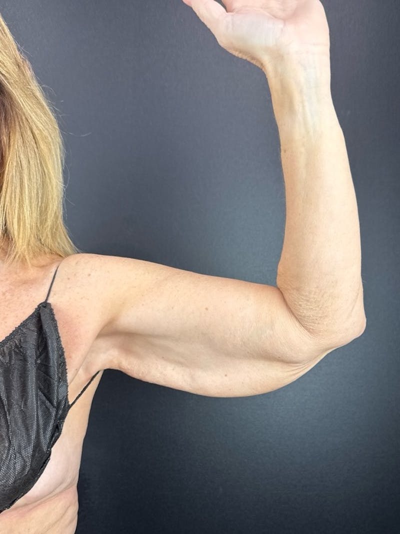 Arm Lift Before & After Gallery - Patient 169576 - Image 1