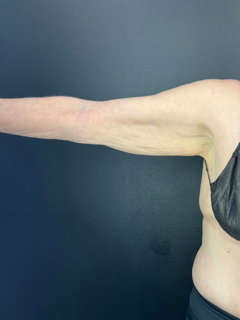 Arm Lift Before & After Gallery - Patient 786026 - Image 1
