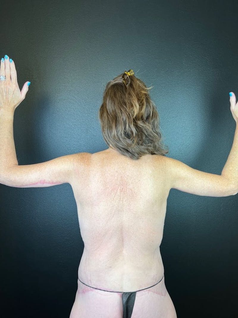 Arm Lift Before & After Gallery - Patient 530047 - Image 2