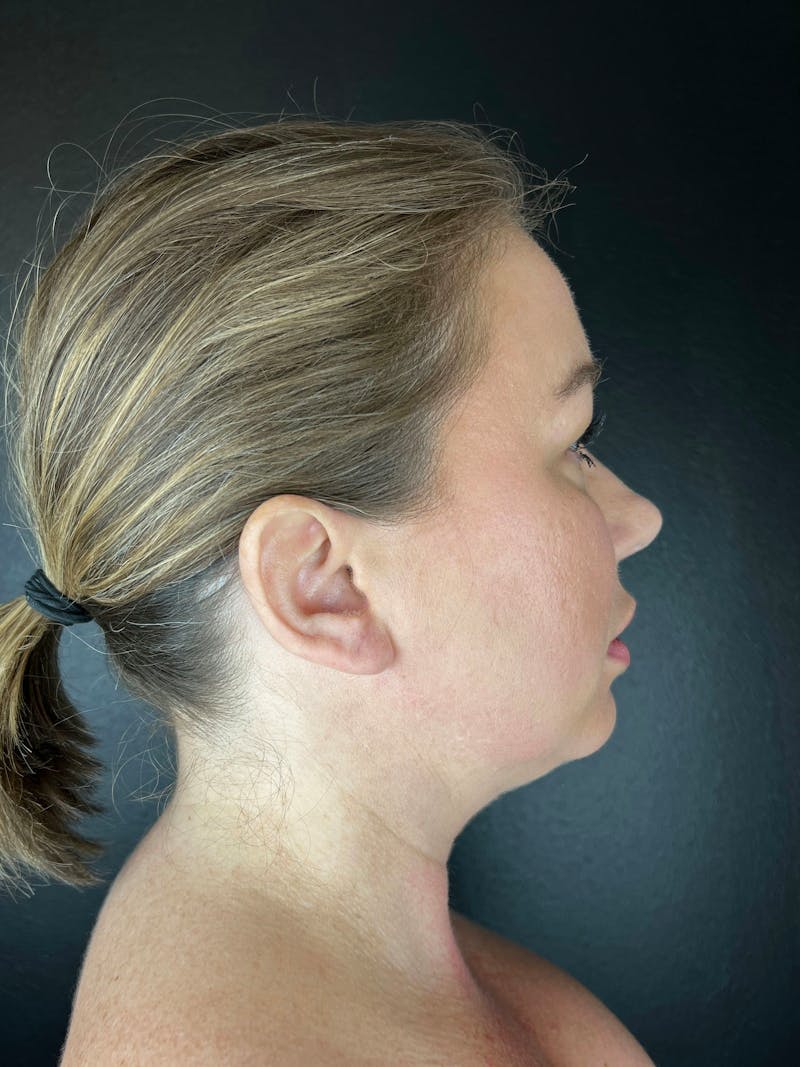 Neck Lift Before & After Gallery - Patient 618246 - Image 1