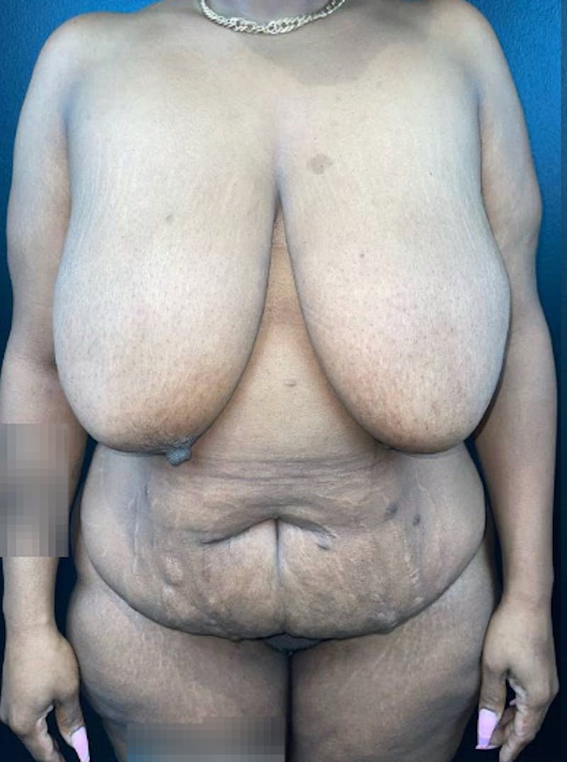 Tummy Tuck Before & After Gallery - Patient 123042 - Image 1