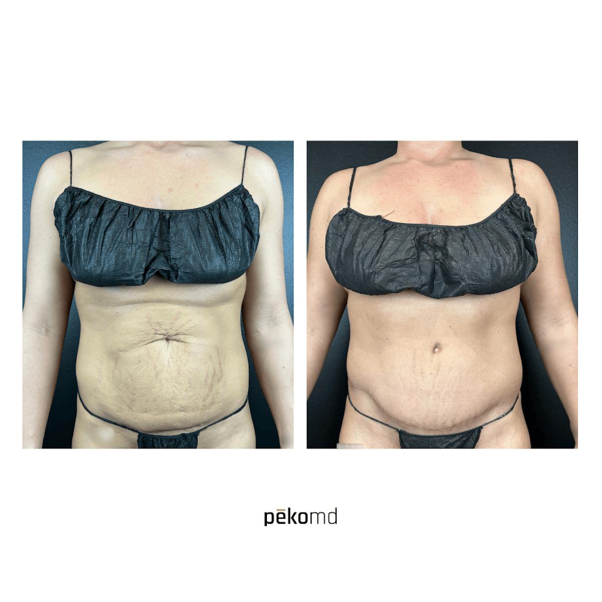 Tummy Tuck Before & After Gallery - Patient 367909 - Image 1