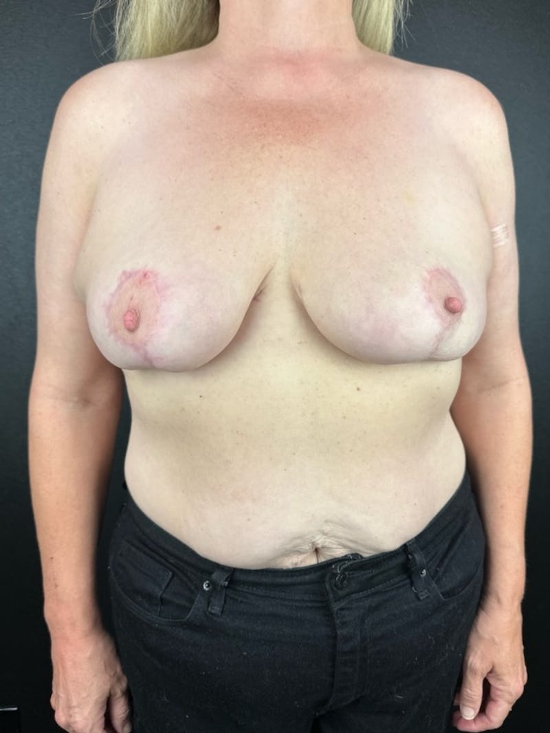 Breast Reduction & Lift Before & After Gallery - Patient 198783 - Image 2