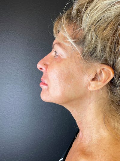Neck Lift Before & After Gallery - Patient 157112 - Image 2