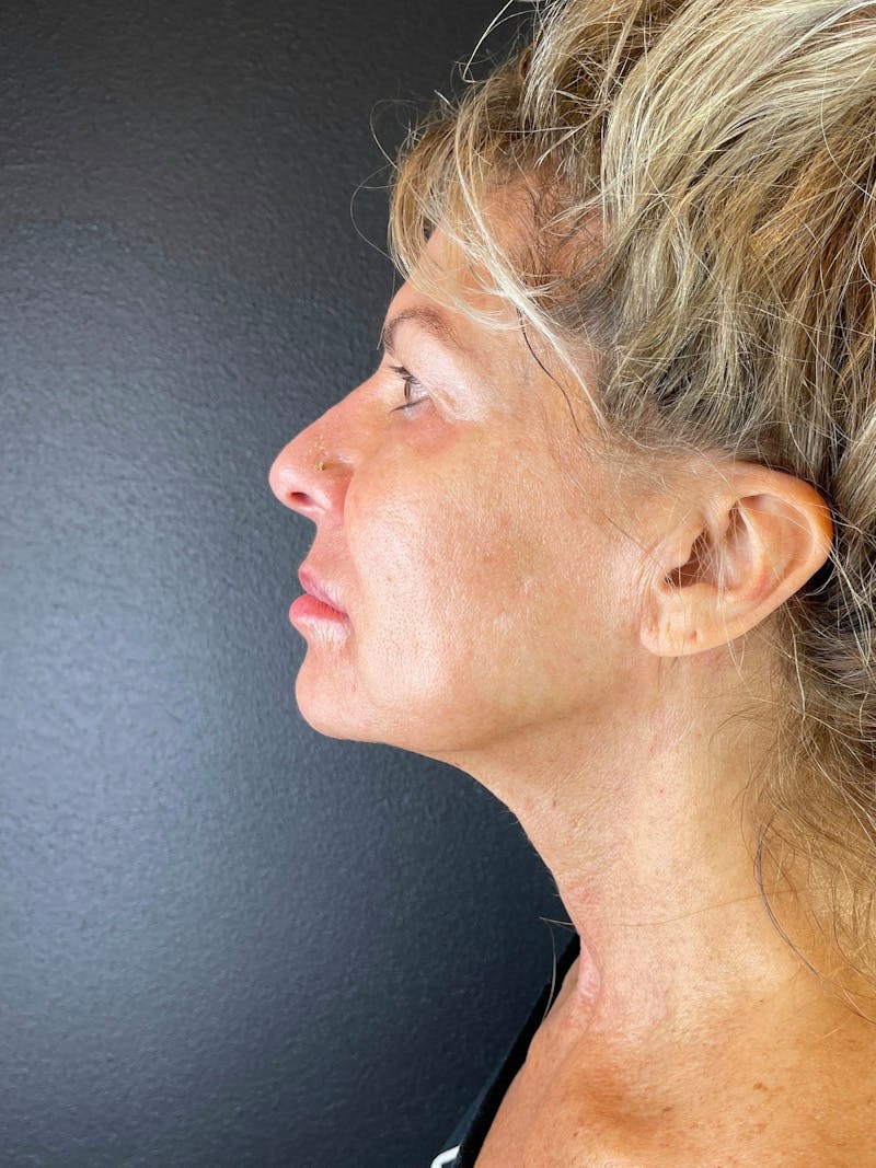 Neck Lift Before & After Gallery - Patient 157112 - Image 2