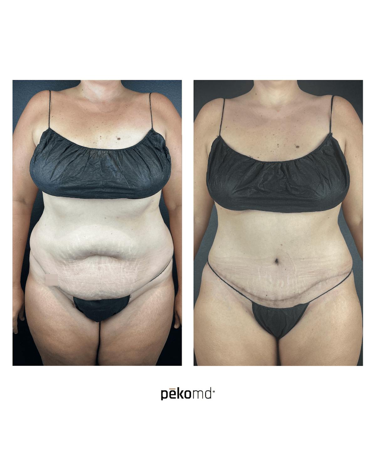 Tummy Tuck Before & After Gallery - Patient 516082 - Image 1