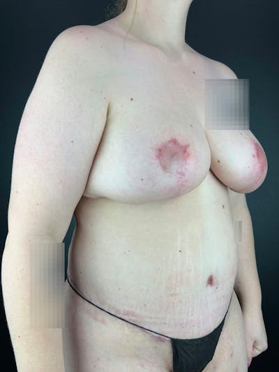 Breast Reduction & Lift Before & After Gallery - Patient 440658 - Image 2