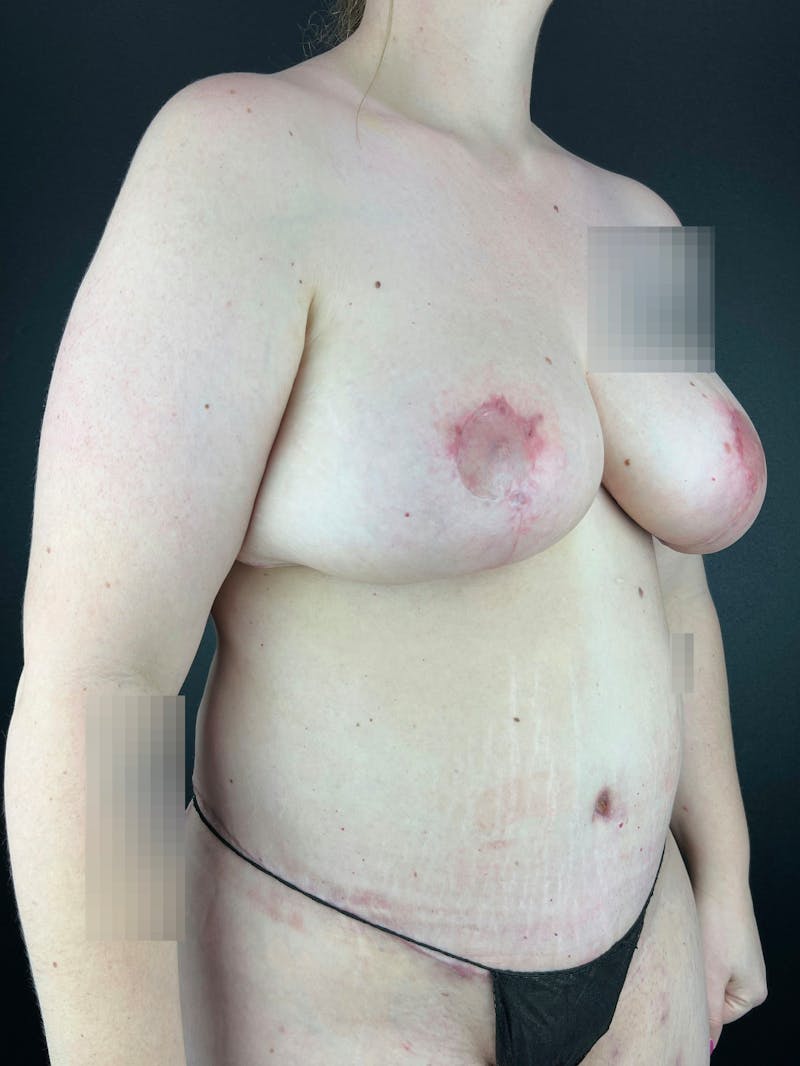 Breast Reduction & Lift Before & After Gallery - Patient 440658 - Image 2