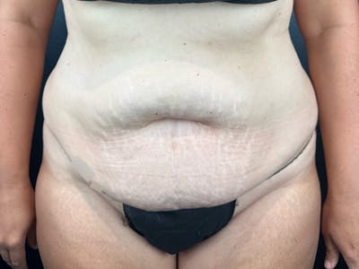 Tummy Tuck Before & After Gallery - Patient 582664 - Image 1