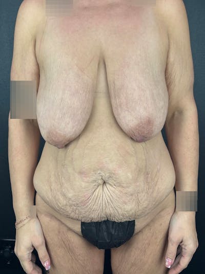 Breast Reduction & Lift Before & After Gallery - Patient 265083 - Image 1