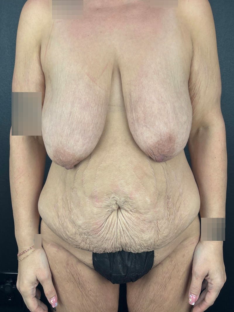 Breast Reduction & Lift Before & After Gallery - Patient 265083 - Image 1