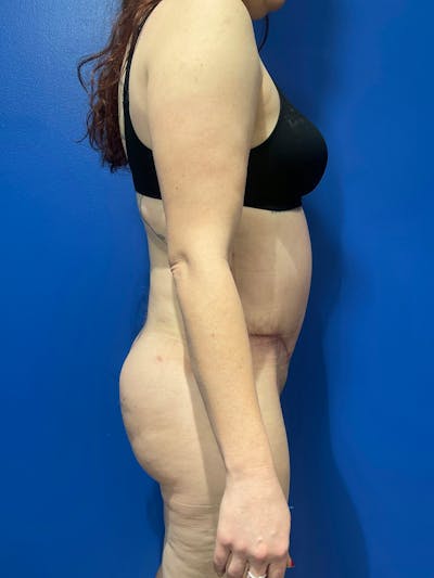 BBL + Aveli  Before & After Gallery - Patient 320340 - Image 2