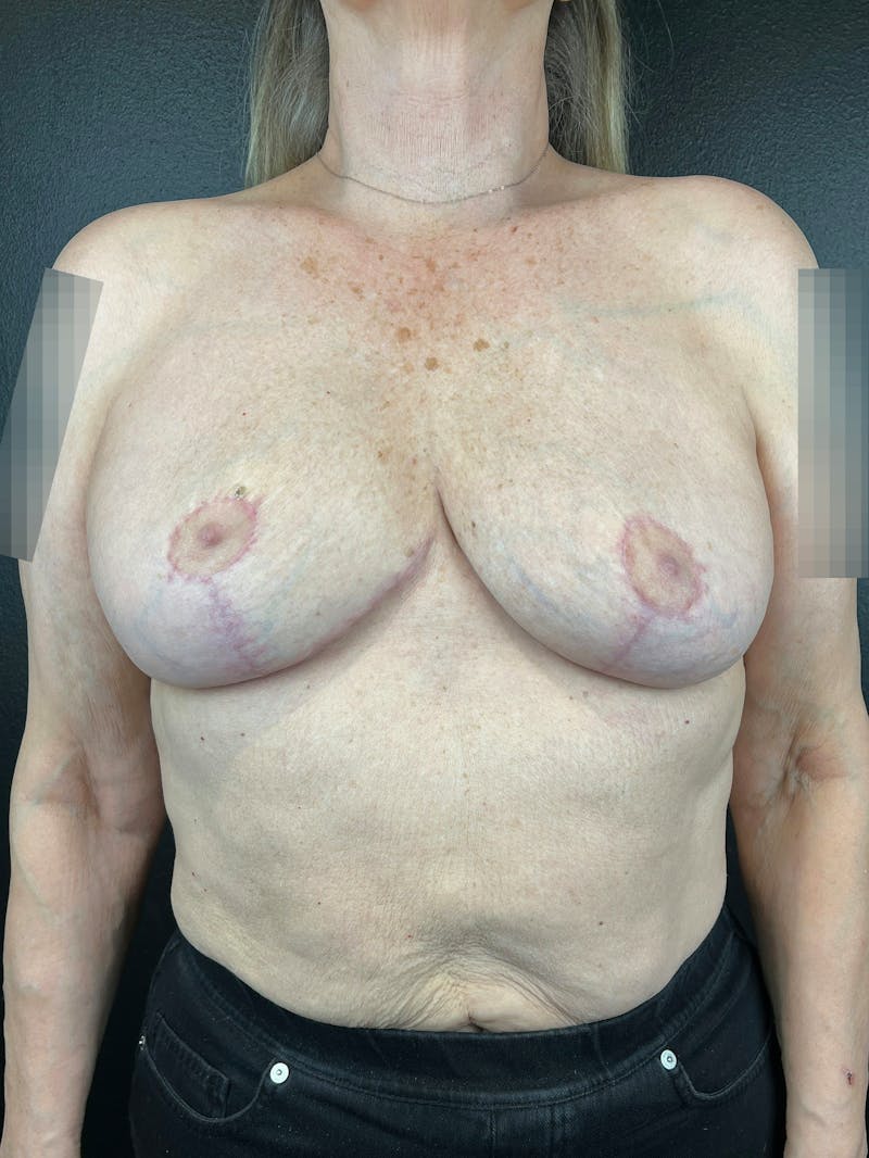 Explant with Breast Lift Before & After Gallery - Patient 148227 - Image 2