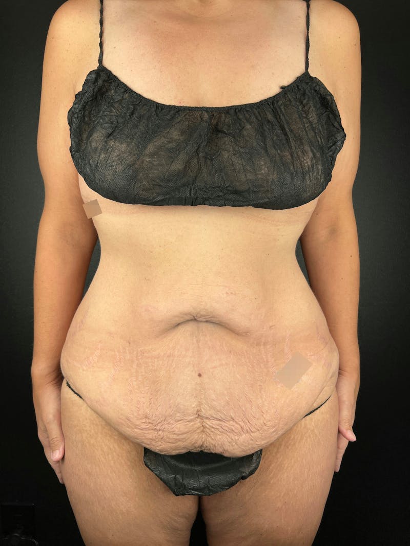 Tummy Tuck Before & After Gallery - Patient 802184 - Image 1
