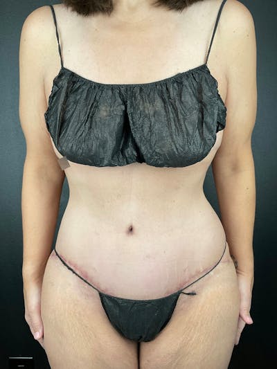 Tummy Tuck Before & After Gallery - Patient 802184 - Image 2