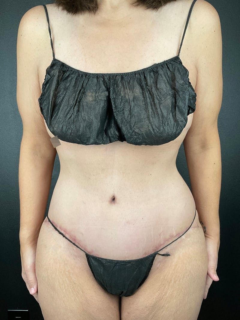 Tummy Tuck Before & After Gallery - Patient 802184 - Image 2