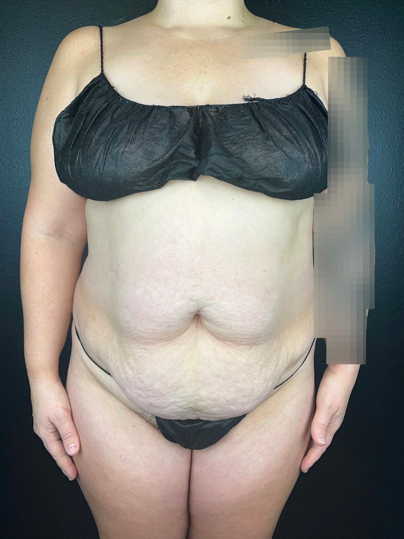Tummy Tuck Before & After Gallery - Patient 357458 - Image 1