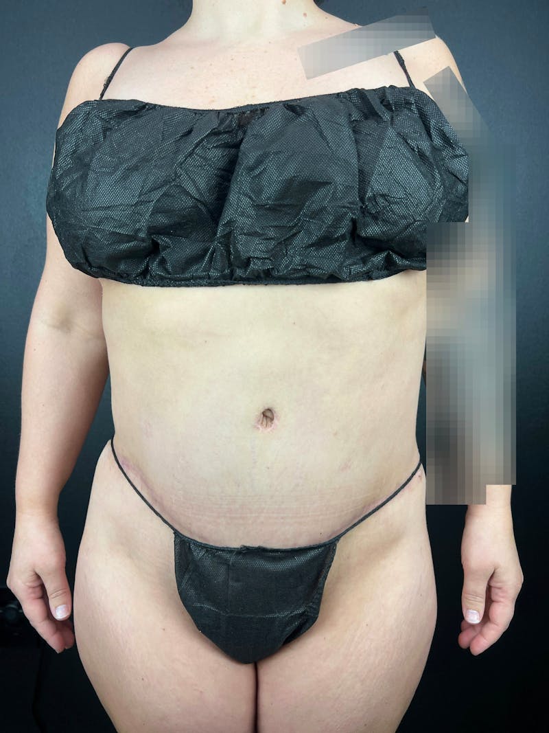 Tummy Tuck Before & After Gallery - Patient 357458 - Image 2