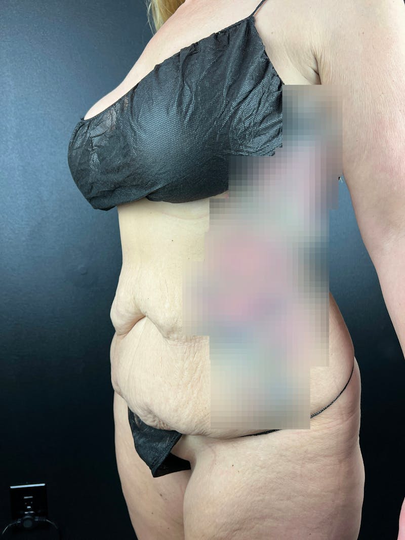 Tummy Tuck Before & After Gallery - Patient 411193 - Image 1