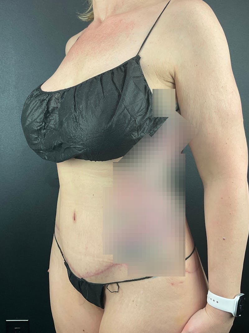Tummy Tuck Before & After Gallery - Patient 411193 - Image 2