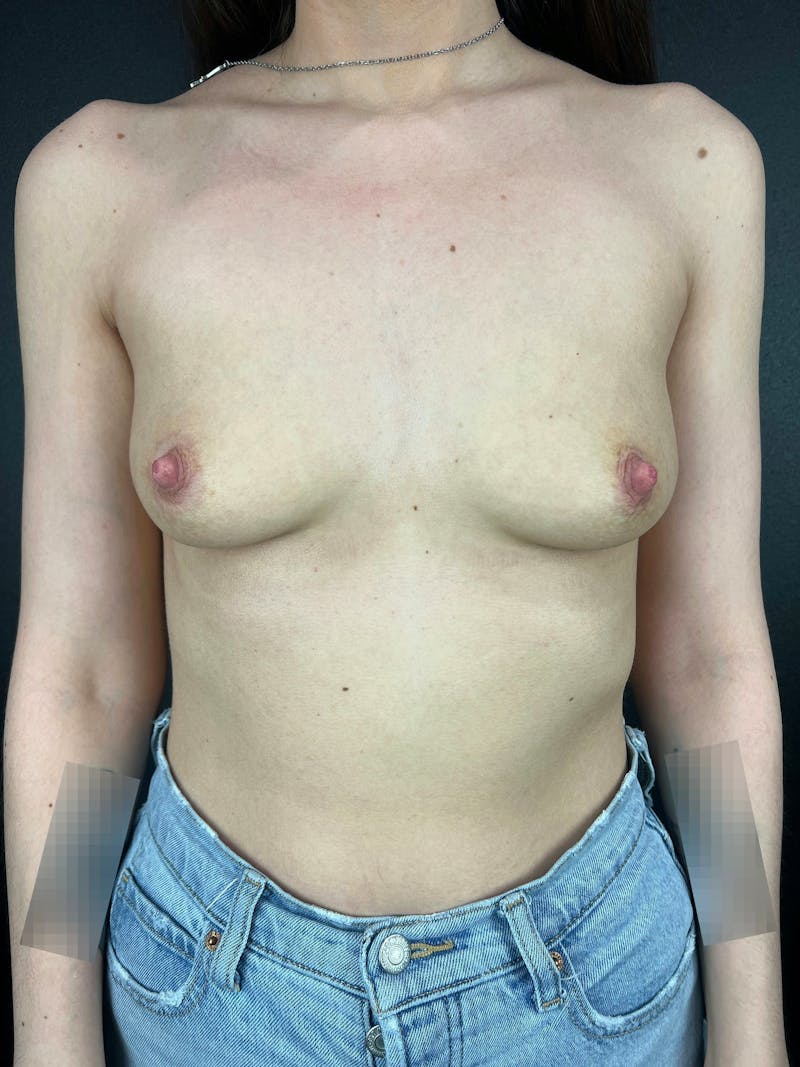 Breast Augmentation Before & After Gallery - Patient 315997 - Image 1