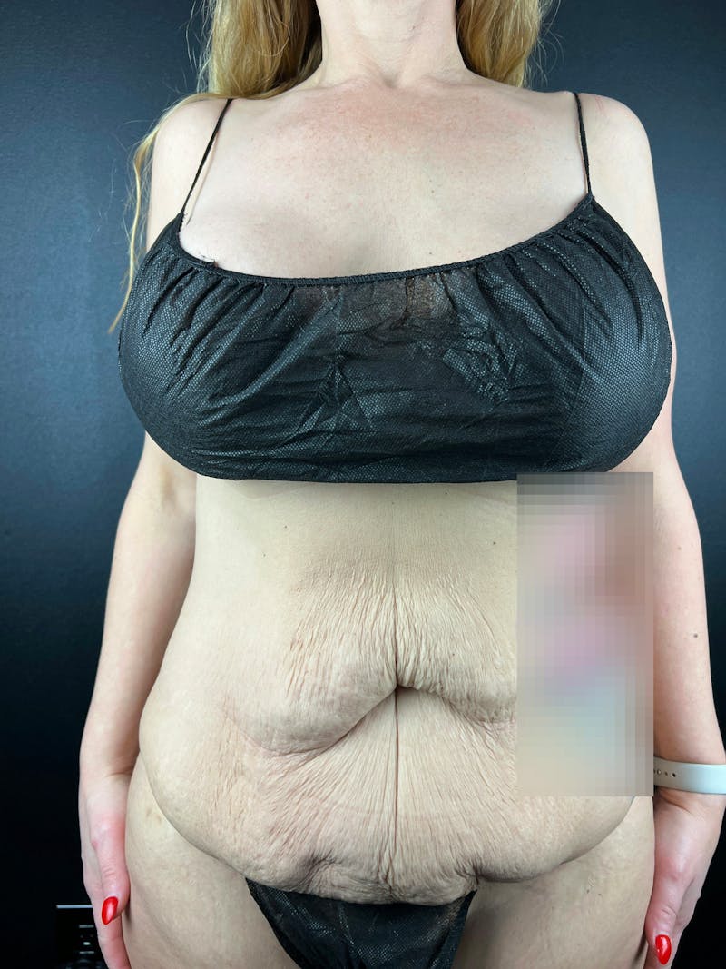 Tummy Tuck Before & After Gallery - Patient 411193 - Image 5