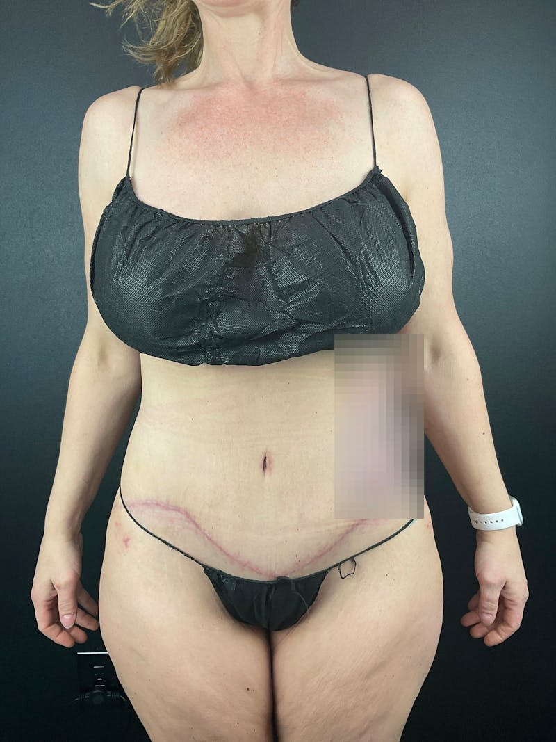 Tummy Tuck Before & After Gallery - Patient 411193 - Image 6