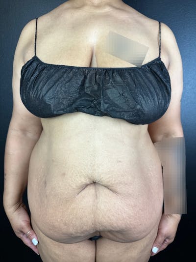 Tummy Tuck Before & After Gallery - Patient 322390 - Image 1