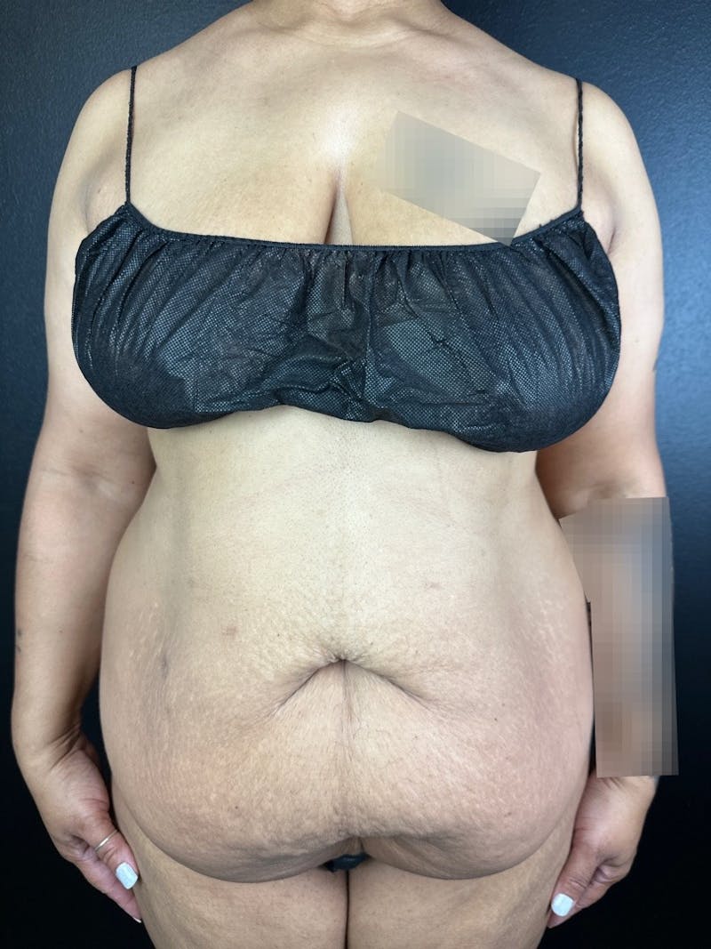 Tummy Tuck Before & After Gallery - Patient 322390 - Image 1