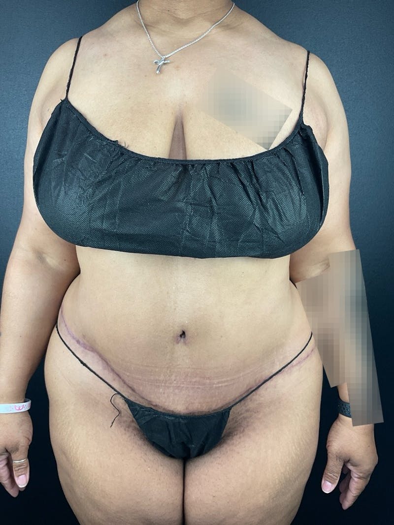 Tummy Tuck Before & After Gallery - Patient 322390 - Image 2