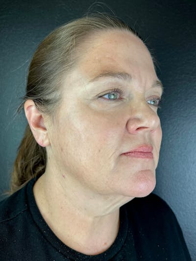 Neck Lift Before & After Gallery - Patient 308846 - Image 1
