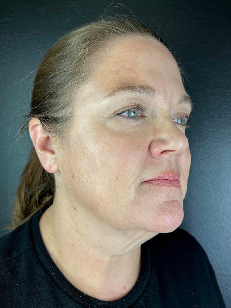Neck Lift Before & After Gallery - Patient 308846 - Image 1