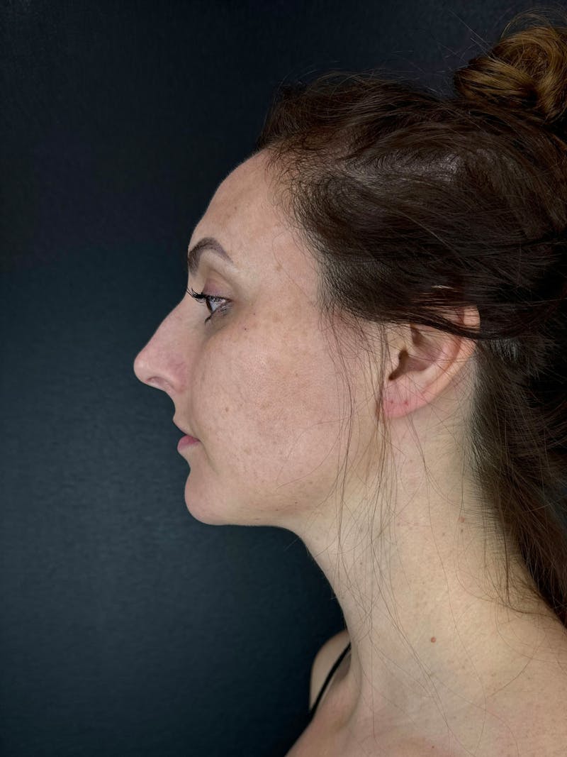 Neck Lift Before & After Gallery - Patient 208984 - Image 2