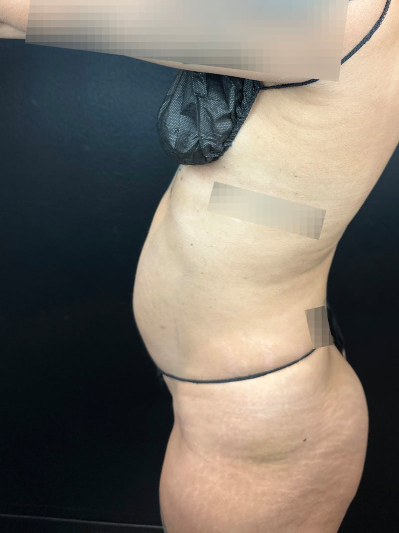 Tummy Tuck Before & After Gallery - Patient 366094 - Image 1
