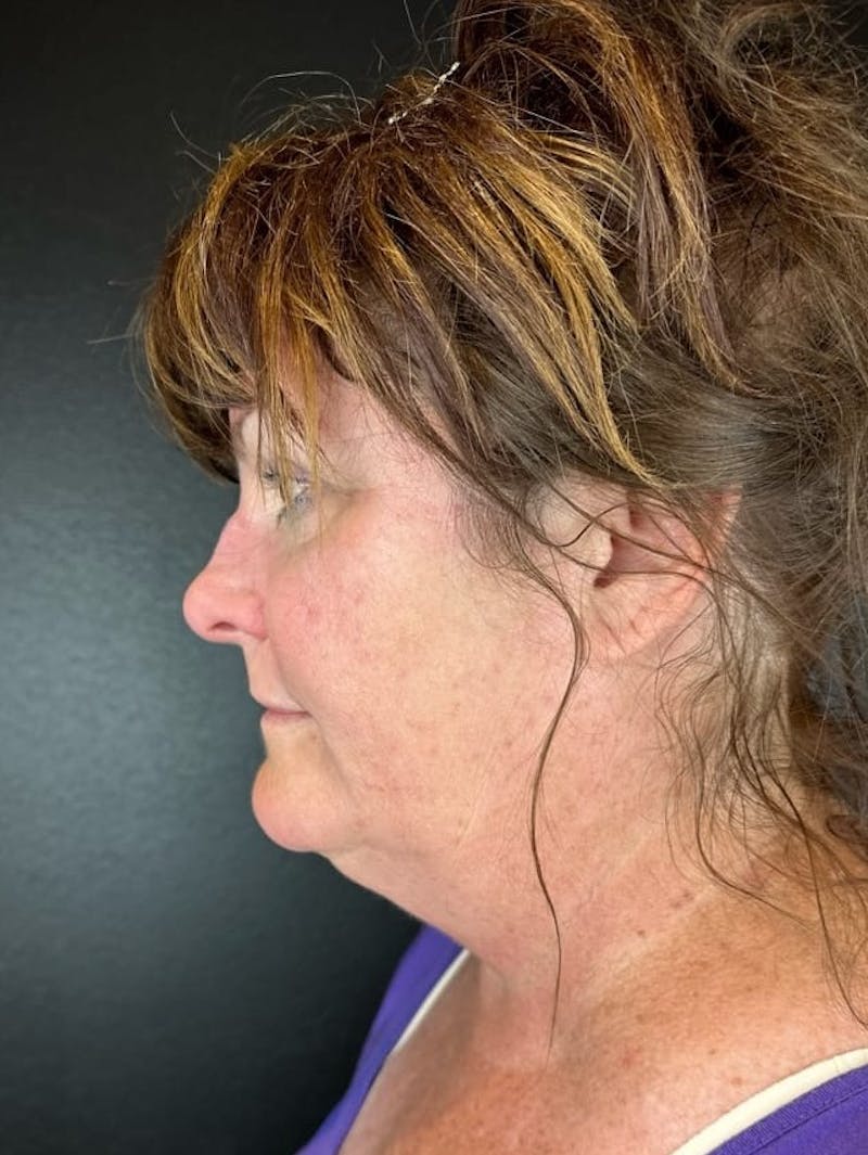 Neck Lift Before & After Gallery - Patient 312327 - Image 1