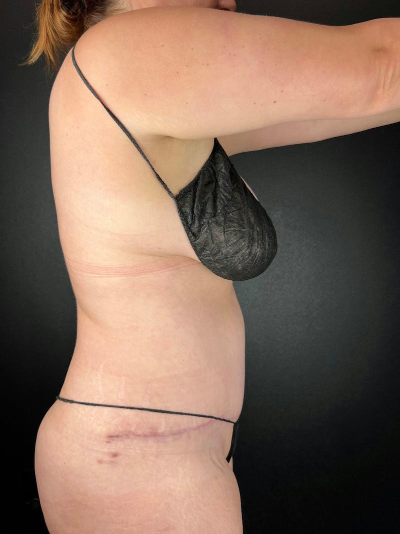 Tummy Tuck Before & After Gallery - Patient 138295 - Image 2